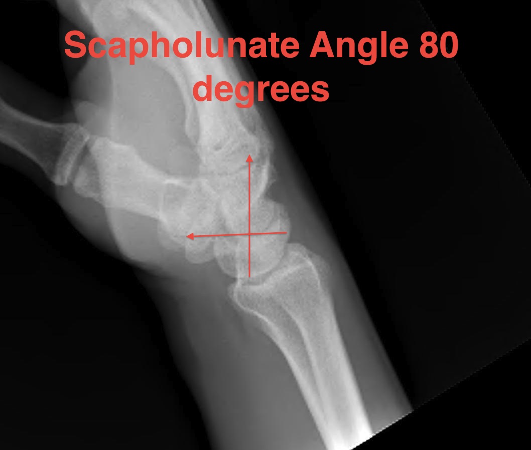 Increased Scapholunate Angle